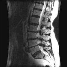 Стеноз спинномозгового канала МРТ